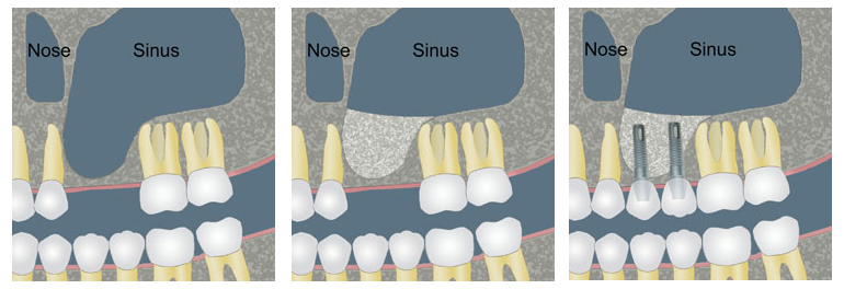 sinus-lift-aponia-dental-center