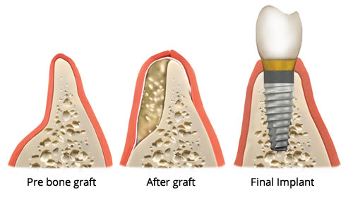 artificial-bone-aponia-dental-center