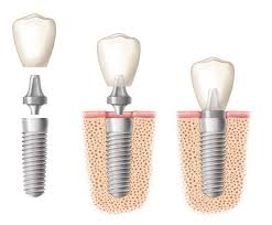 implant-structure-adc