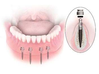 mini-implants-aponia-dental-center