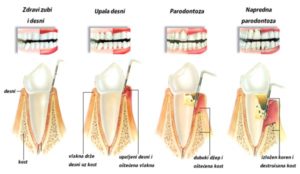 Parodontopatija u fazama