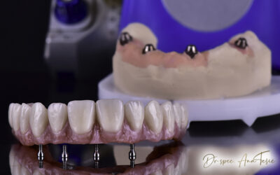 Kompletno saniranje vilice zubnim implantima