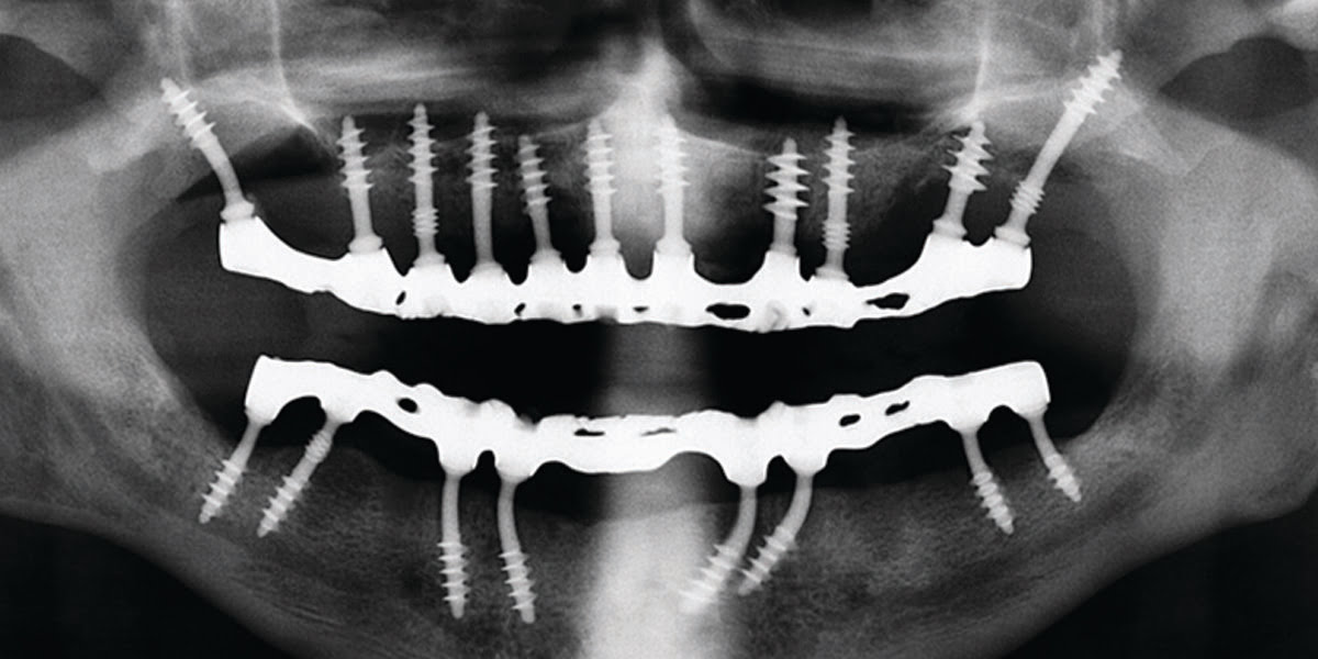Implant02